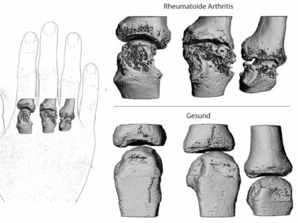 XtremeCT scan of the metacarpophalangeal joints in a healthy state (below) and in a patient with advanced rheumatoid arthritis (Image: FAU/A.Kleyer/Department of Medicine 3)